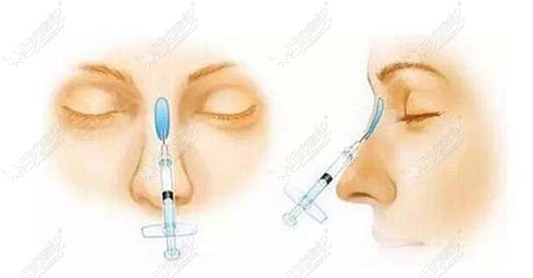 肋骨鼻一年后鼻头断层的解决方法