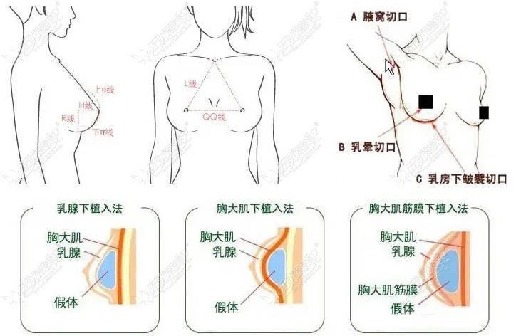 假体隆胸切口