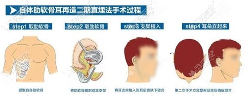 肋骨耳朵的手术过程