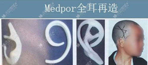 人工材料Medpor再造耳的成效