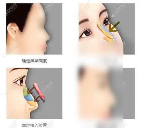 胡宝川做的耳软骨前后对比 胡宝川做的耳软骨前后对比