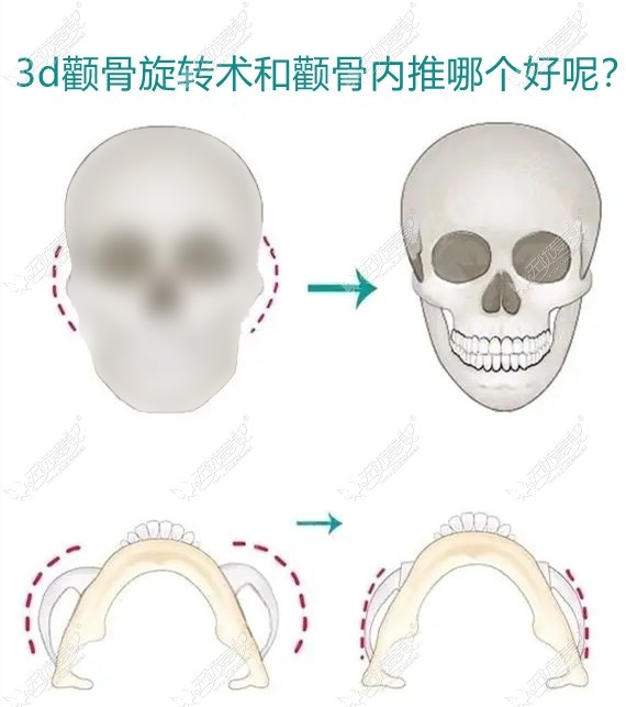 3d颧骨旋转术和颧骨内推哪个好?除了价格,手术过程也有区别