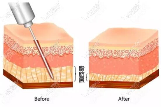 吸脂手术后脂肪层对比变化图片