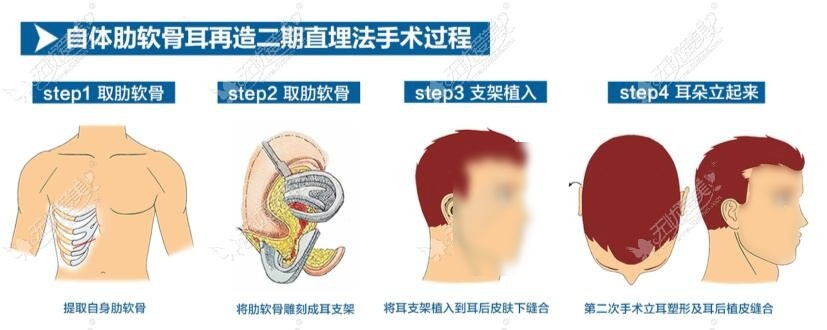 自体助软骨耳再造二期直埋法手术过程