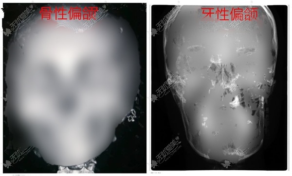 骨性偏颌和牙性偏颌从X光片上的区别