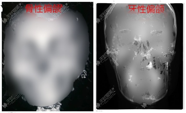 13岁孩子偏颌导致脸歪怎么办?要是牙性通过矫正牙齿能恢复