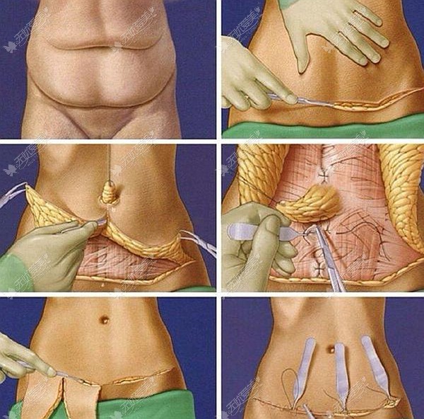 这有腹部拉皮手术前后对比照片，术后肚子确实会变小哟
