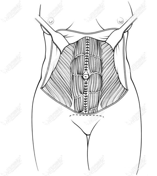 腹壁成形手术切口位置