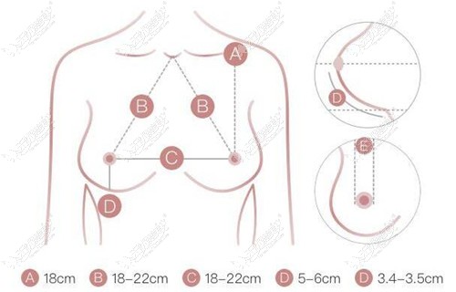 隆胸前胸部测量图片