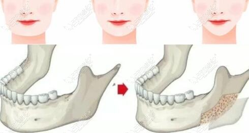 张笑天下颌角磨骨前后对比图