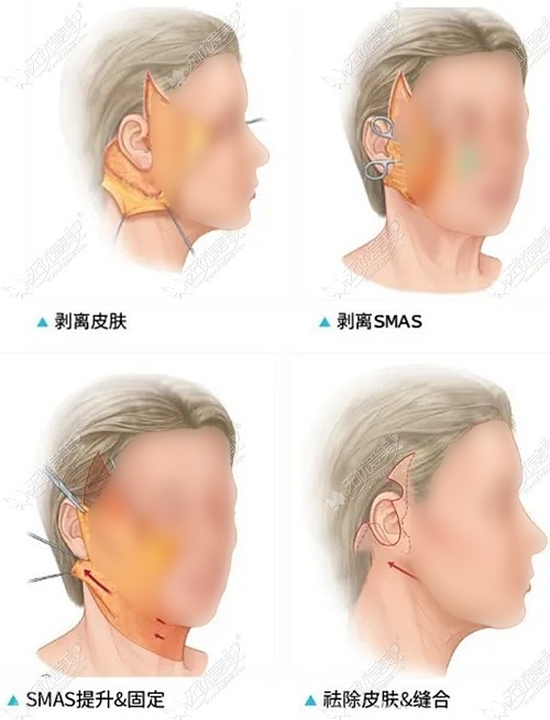 在东莞做拉皮能维持多久