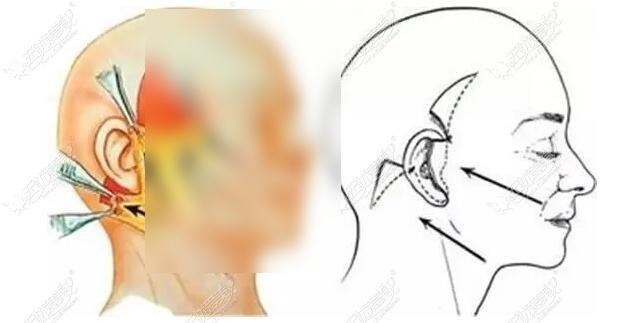 pst面部提升手术图