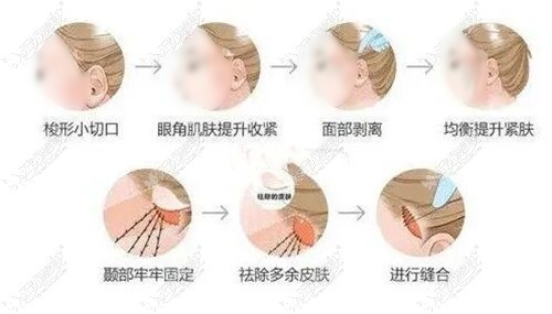 面部小切口拉皮过程