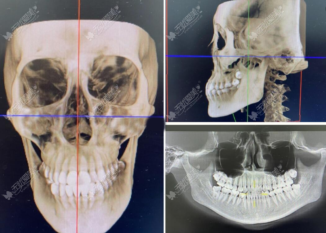 张立天下颌角磨骨前后对比图