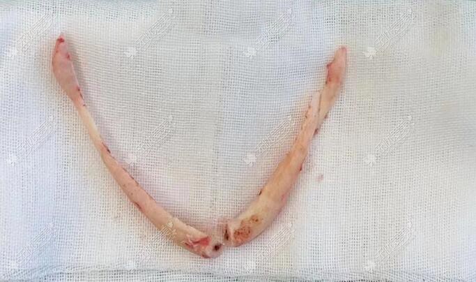 姜民范做下颌角手术的截骨图