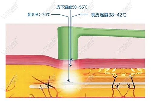 黄金微雕和光纤溶脂哪个维持的更久点