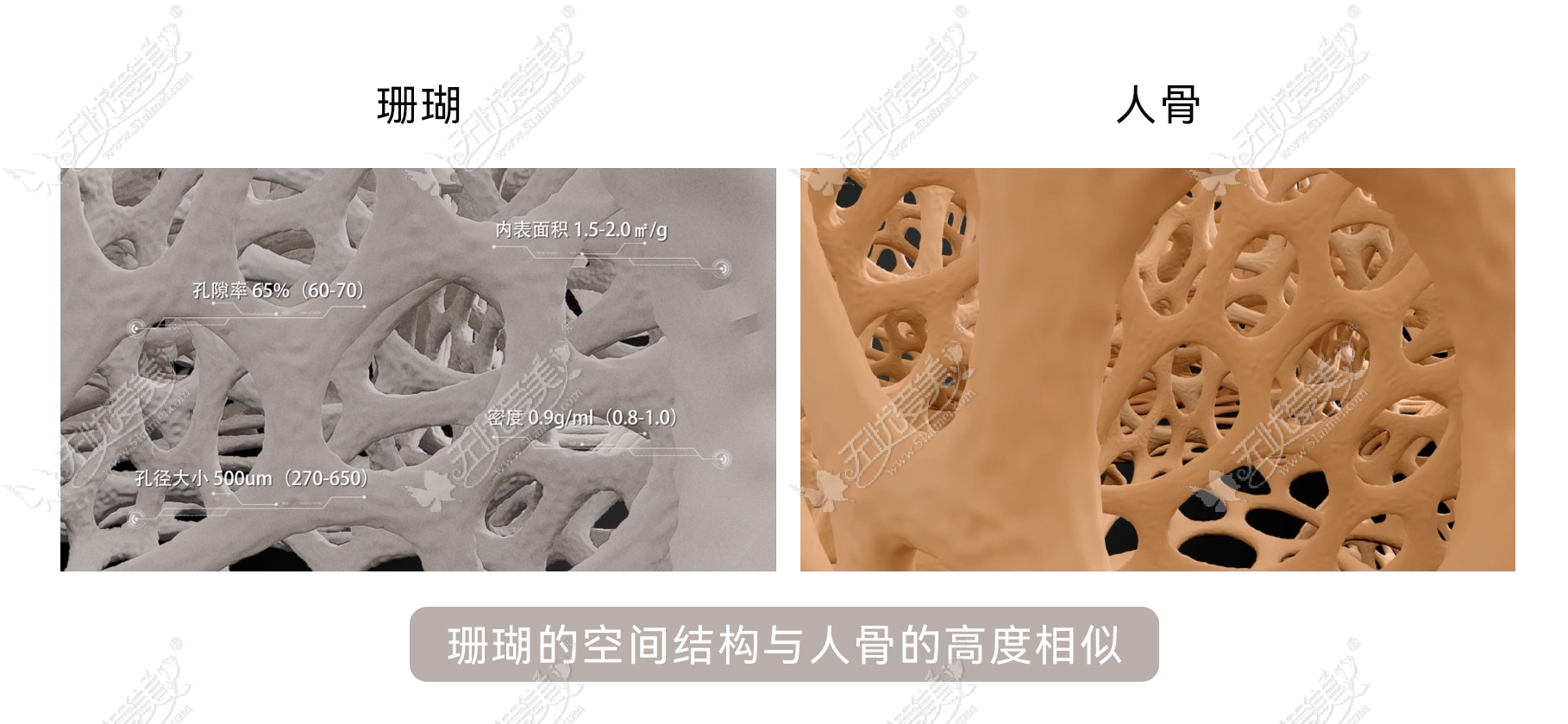 頸椎人工脊椎 - F3D - Corelink Surgical - 3Dプリント