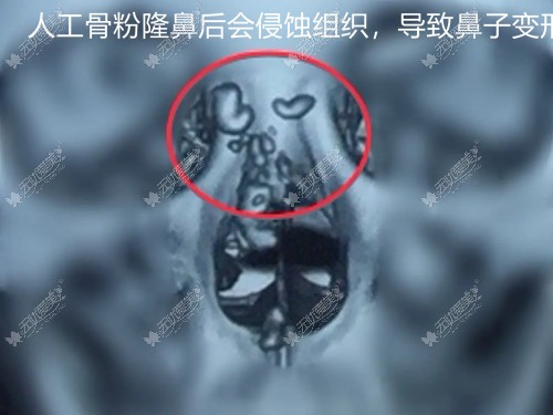 人工骨粉隆鼻后拍摄CT图侵蚀人体组织