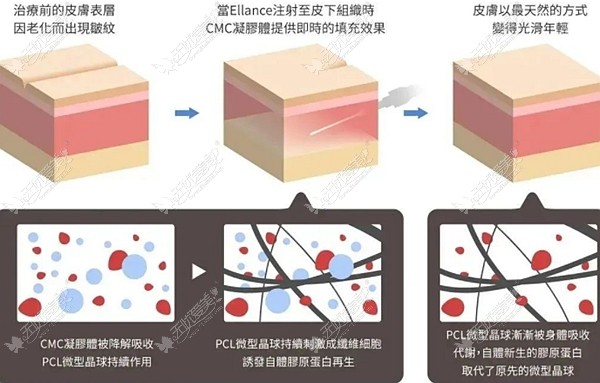 伊妍仕少女针填充鼻子怎么样