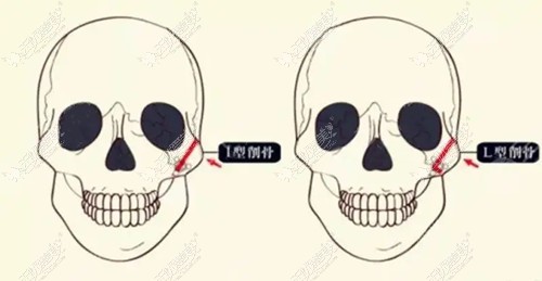 颧骨内推I型截骨和L型截骨的区别:除了手术方法不同还有...