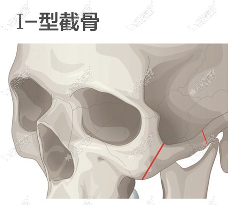 颧骨内推I型截骨手术方法