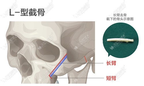 颧骨内推L型截骨手术方法