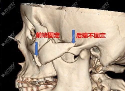 颧骨内推I型固定方式