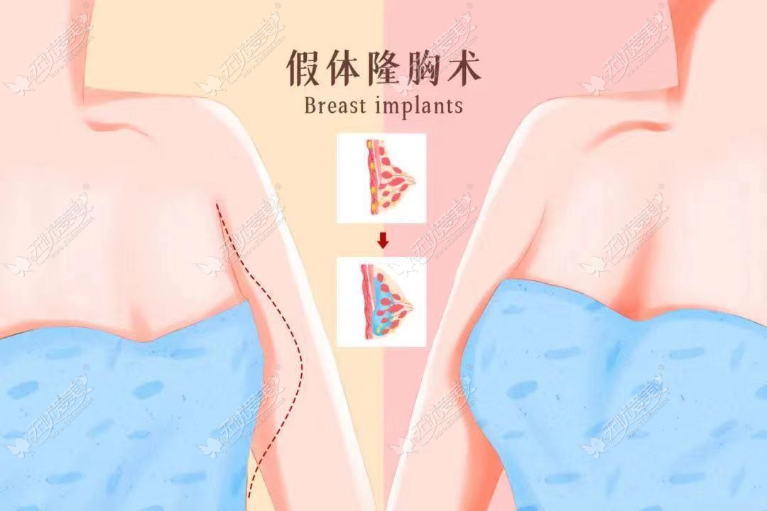 株洲好的隆胸整容医院排名