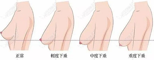 胸下垂做悬吊的前后比较图片,乳房悬吊提升后乳头没有内陷