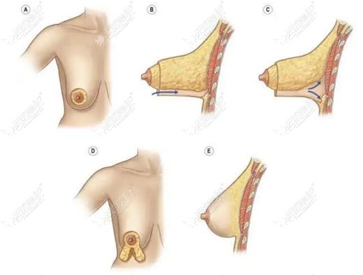 乳房悬吊提升后乳头会内陷吗?