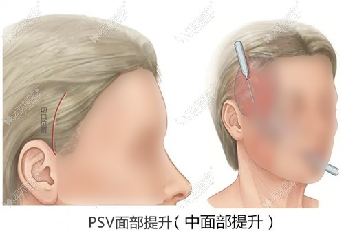 PSV面部提升手术过程