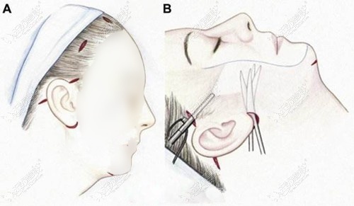 五层面部提升手术切口位置