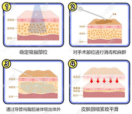 重庆郑荃吸脂技术