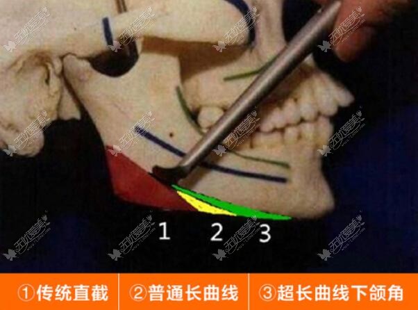 广州广大医院长曲线下颌角截骨技术特色