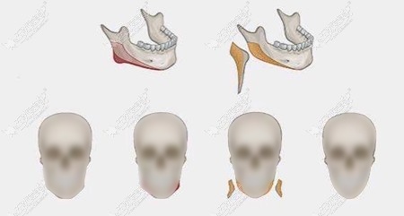 李志海下颌角磨骨技术解析