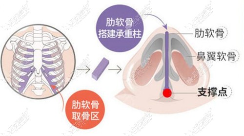 www.51aimei.com提供的杨万忠做鼻子技术图