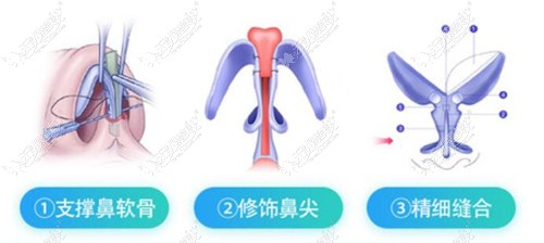 曾熬医生做鼻综合技术优势