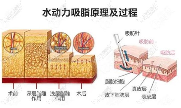 吸脂的手术原理