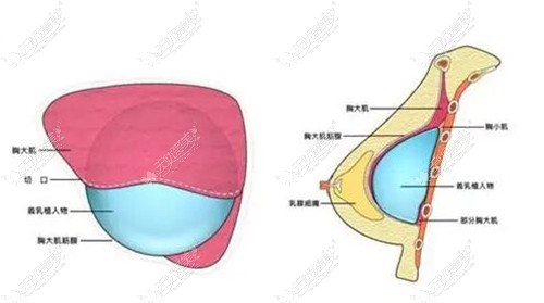 黄广香医生假体置入的位置