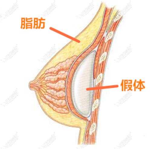 复合隆胸手术