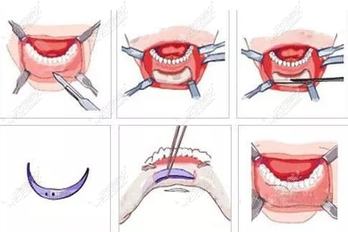 正颌手术步骤