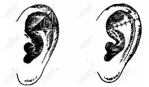 耳再造手术对比图51aimei.com