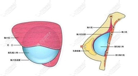 www.51aimei.com上海美莱隆胸技术图