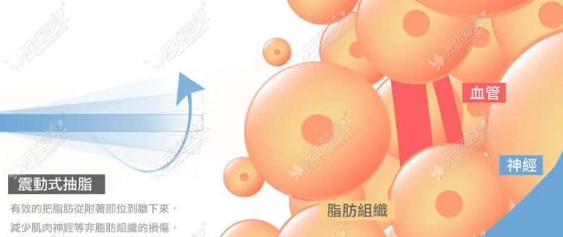 www.8682.cc东莞美立方吸脂技术图