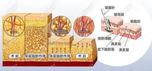 东莞天后吸脂技术图