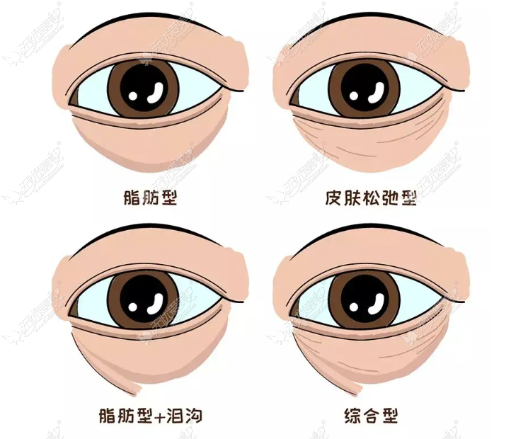 湖州割眼袋实例www.51aimei.com 湖州割眼袋实例www.51aimei.com