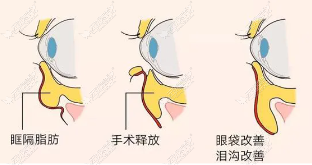 湖州去眼袋价格表 湖州去眼袋价格表