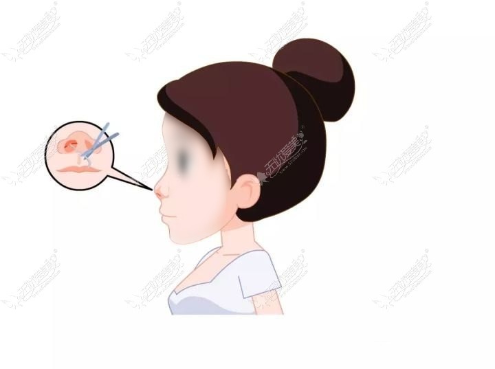 惠州隆鼻哪家医院好?排名前三家做假体/肋骨鼻综合手术好