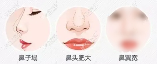 南宁华美卢志刚做鼻子好看么www.51aimei.com 南宁华美卢志刚做鼻子好看么www.51aimei.com