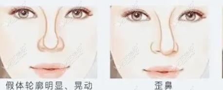 杭州做鼻修复比较出名的医生